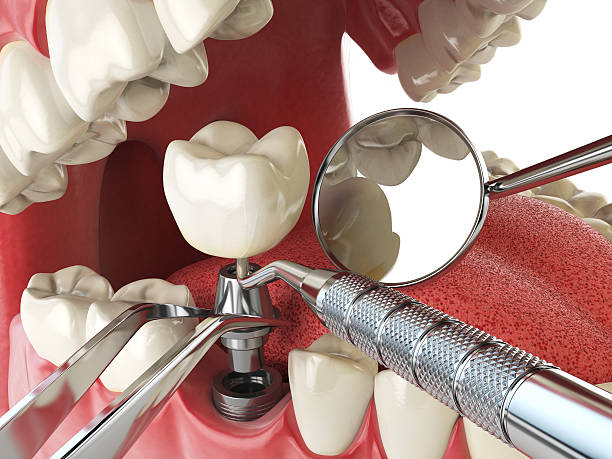 Best Emergency Root Canal Treatment in Livonia, LA