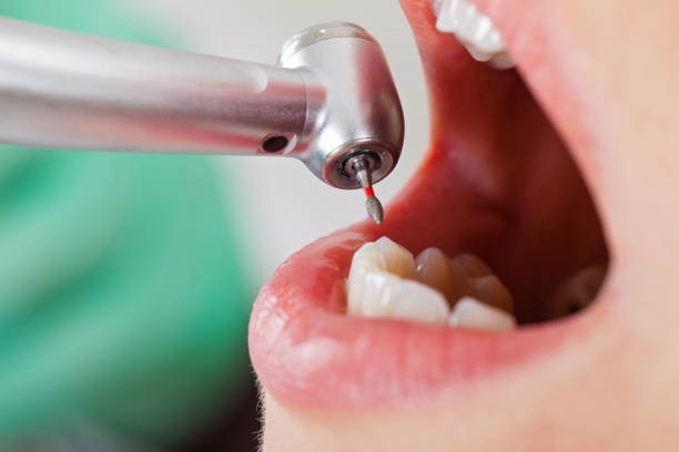 Best Broken or Cracked Tooth Emergency Dentist in Livonia, LA